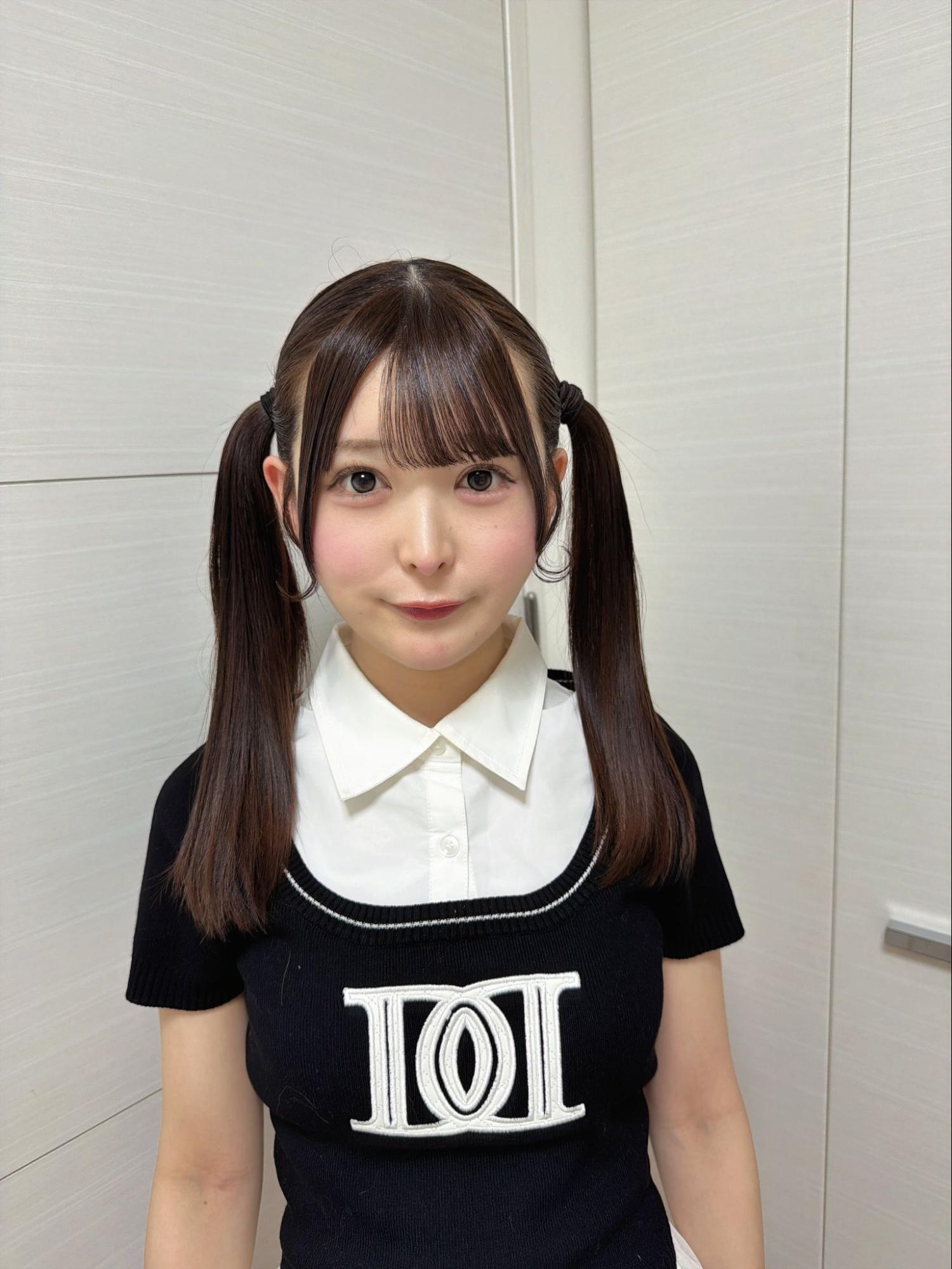 脂肪吸引注射(あご下)の経過:術後1週間の症例写真と傷跡